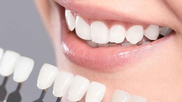 bai-viet/dan-su-veneer-co-may-loai-va-nhung-luu-y-khi-dan-rang-su-63708.html