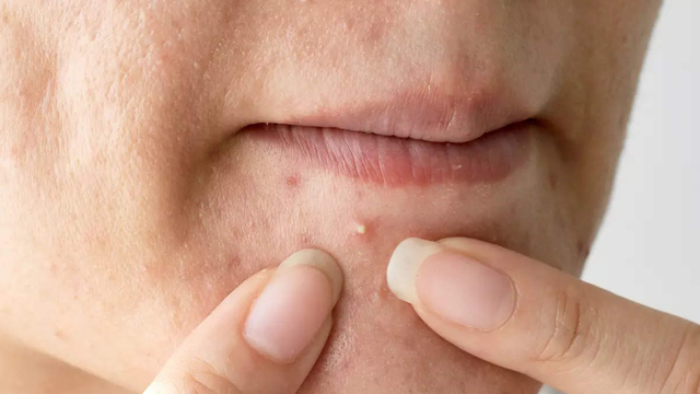 bai-viet/danh-bay-not-mun-trung-ca-kho-ua-voi-mieng-dan-mun-derma-angel.html