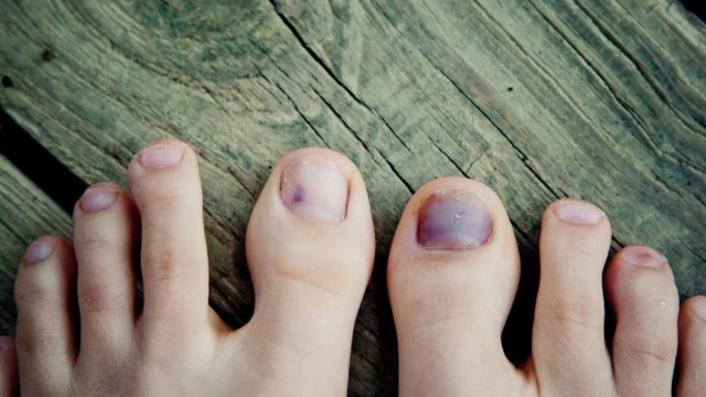 bai-viet/dap-mong-chan-kieng-an-gi-cham-soc-nhu-the-nao.html