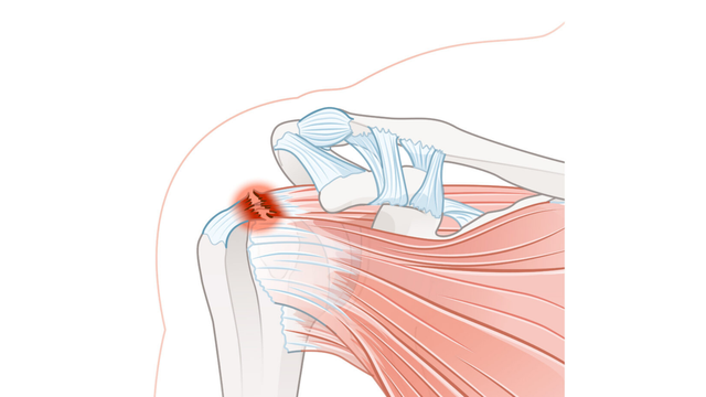 benh/dau-ba-vai.html