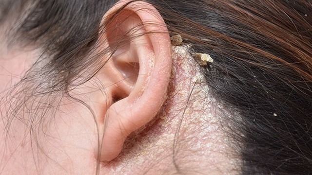 bai-viet/dau-goi-tri-viem-da-tiet-ba-duoc-review-hieu-qua-66551.html