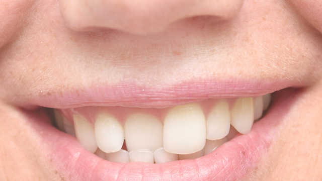 bai-viet/dau-hieu-moc-rang-khenh-dep-la-gi-cac-ky-thuat-chinh-nha-cho-rang-khenh.html