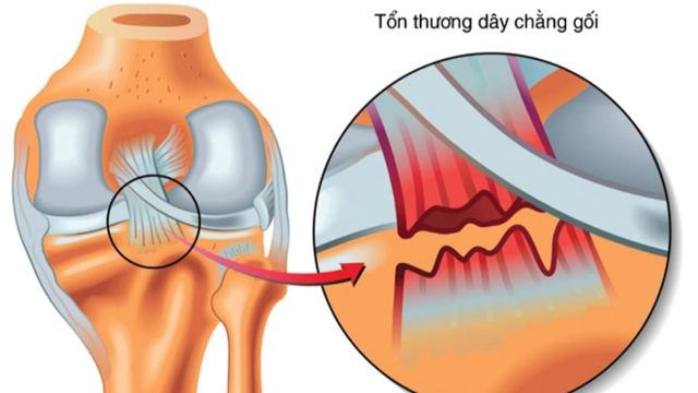 bai-viet/dau-hieu-dut-day-chang-cheo-truoc-ma-ban-nen-biet.html