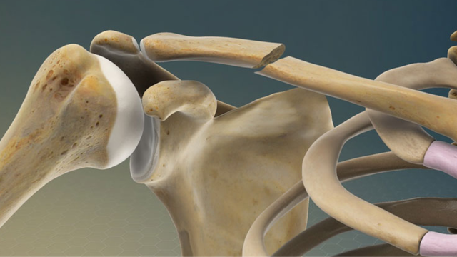 bai-viet/gay-kin-1-3-giua-xuong-don-la-gi-nguyen-nhan-dau-hieu-va-muc-do-nguy-hiem.html