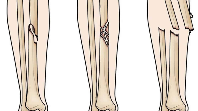 bai-viet/gay-xuong-cang-chan-dau-hieu-cach-dieu-tri-va-phuong-phap-phong-ngua.html