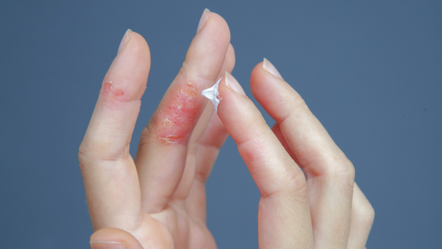 bai-viet/dau-hieu-nhan-dien-viem-da-co-dia-o-tung-do-tuoi-the-nao.html