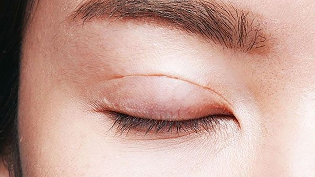 bai-viet/dau-hieu-nhan-mi-bi-lo-chi-cach-khac-phuc-hieu-qua-va-nhanh-chong-66307.html