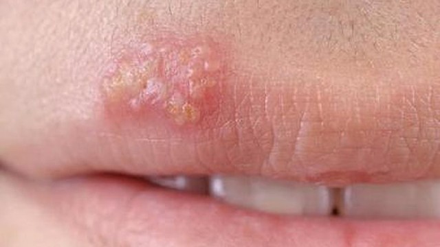 bai-viet/dau-hieu-noi-mun-nuoc-o-moi-la-gi-co-phong-ngua-duoc-khong-58318.html