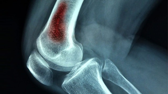 bai-viet/dau-hieu-sarcoma-xuong-o-tre-em-va-thanh-thieu-nien-khong-nen-bo-qua-63437.html