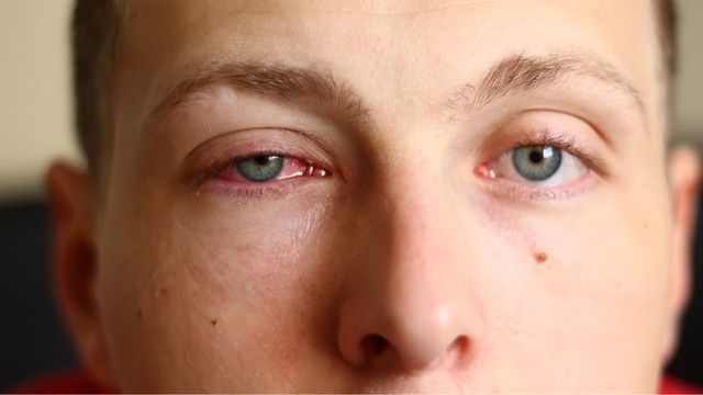 bai-viet/dau-mat-do-khi-nao-het-lay-cach-phong-benh-dau-mat-do.html