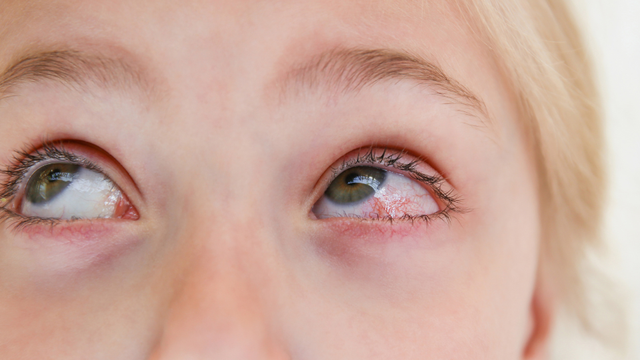 bai-viet/dau-mat-do-o-tre-em-va-dau-hieu-o-tung-giai-doan-ba-me-can-luu-y.html