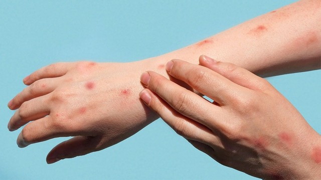 bai-viet/dau-mua-khi-co-chua-duoc-khong-cac-bien-phap-dieu-tri.html