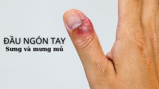 bai-viet/lam-gi-khi-dau-ngon-tay-bi-sung-va-co-mu.html