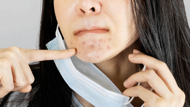 bai-viet/deo-khau-trang-bi-mun-lam-sao-de-khac-phuc.html