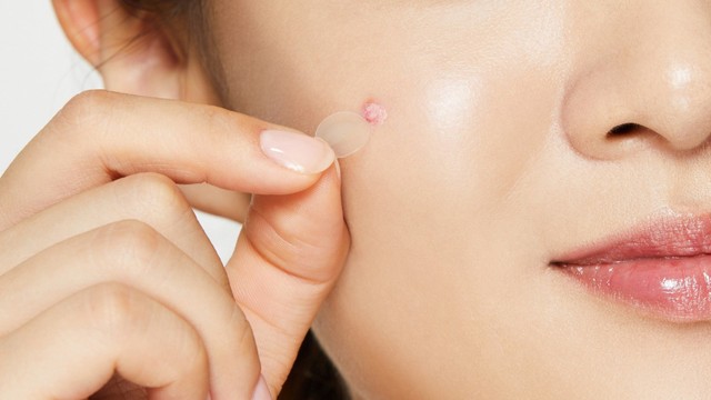 bai-viet/derma-angel-bi-quyet-cai-thien-lan-da-mun-hieu-qua.html