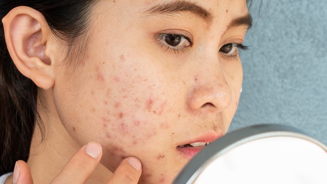 bai-viet/derma-forte-va-epiduo-su-khac-nhau-va-cach-ket-hop-hieu-qua-an-toan.html