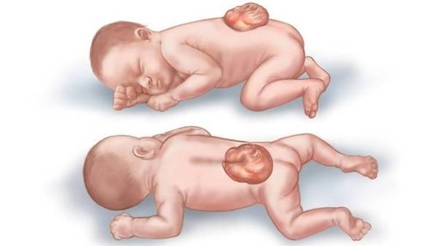 bai-viet/di-tat-cot-song-che-doi-la-gi-chan-doan-va-dieu-tri-nhu-the-nao.html