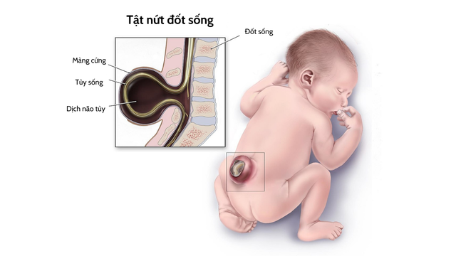 bai-viet/di-tat-cot-song-thai-nhi-thuong-gap-va-cach-phong-ngua.html