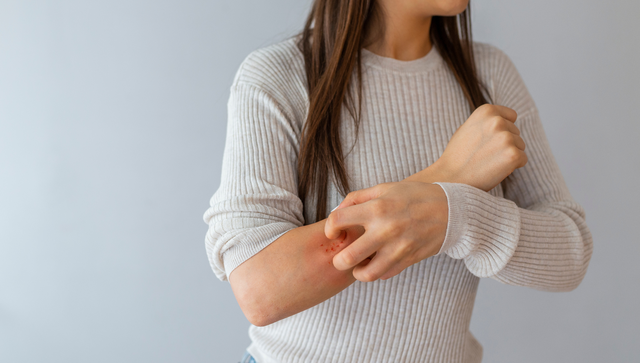 Dị ứng hải sản