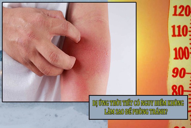 bai-viet/di-ung-thoi-tiet-co-nguy-hiem-khong-lam-sao-de-phong-tranh-di-ung-thoi-tiet-47699.html