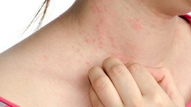 bai-viet/di-ung-thoi-tiet-la-gi-top-3-thuoc-di-ung-thoi-tiet-boi-ngoai-da.html