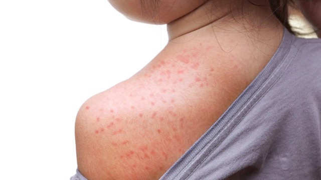 bai-viet/di-ung-thoi-tiet-nong-noi-man-do-nguyen-nhan-va-cach-dieu-tri.html