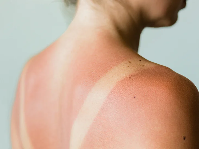 bai-viet/dieu-gi-se-xay-ra-neu-ban-bi-chay-nang-nhieu-lan.html