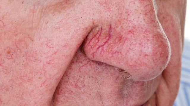 bai-viet/dieu-tri-gian-mao-mach-mui-nhu-the-nao.html