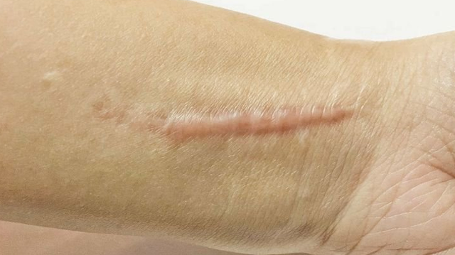 bai-viet/dieu-tri-seo-phi-dai-bao-lau-thi-khoi-61824.html