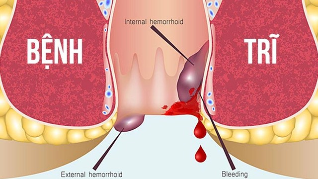 bai-viet/nhung-dieu-can-biet-ve-phuong-phap-that-tri-bang-vong-cao-su.html