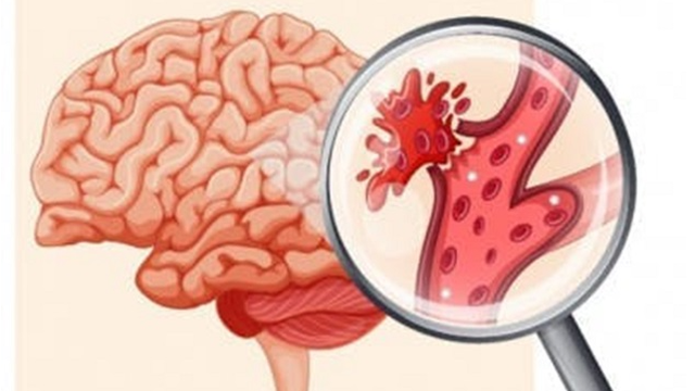 bai-viet/dieu-tri-xuat-huyet-nao-do-vo-di-dang-mach-mau-nao-va-cach-cham-soc-sau-xuat-huyet-nao.html