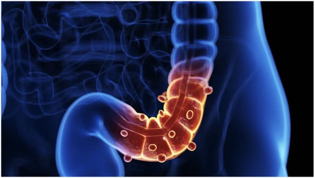 bai-viet/diverticulitis-la-gi-nguyen-nhan-trieu-chung-cach-chan-doan-va-dieu-tri.html