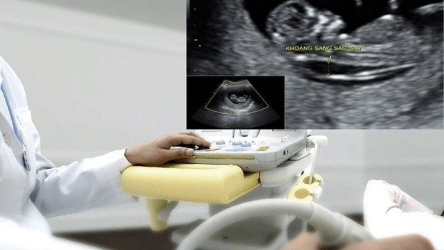 bai-viet/do-mo-da-gay-3-2mm-co-binh-thuong-khong.html