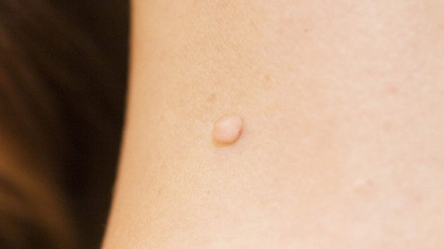 bai-viet/dot-mun-thit-gia-bao-nhieu-cach-cham-soc-sau-khi-dot-mun-thit.html