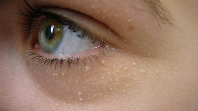 bai-viet/dot-mun-thit-kieng-an-gi-de-khong-bi-seo-va-nhanh-lanh.html