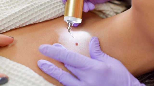 bai-viet/dot-sui-mao-ga-bao-lau-thi-khoi-co-de-lai-seo-khong.html