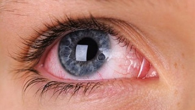 bai-viet/giai-phap-cho-van-de-dui-mat-bi-sung-trong-trang.html