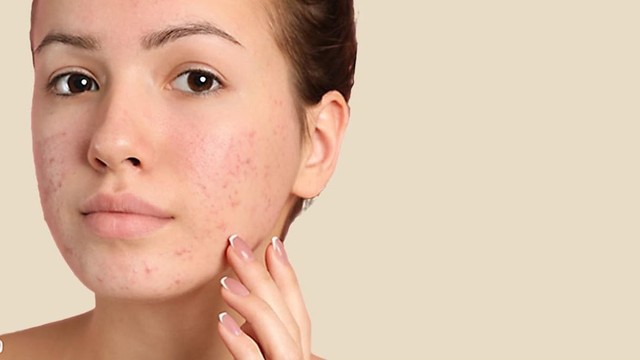 bai-viet/dung-aspirin-tri-mun-co-that-su-an-toan-va-hieu-qua-hay-khong-70152.html