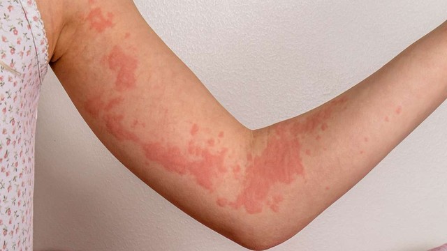 bai-viet/dung-dich-xit-ngoai-da-skin-herbal-lam-diu-vet-ngua-va-giam-me-day-hieu-qua.html