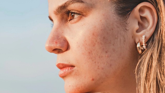 bai-viet/tai-sao-dung-kem-chong-nang-bi-mun-chon-kem-chong-nang-khong-so-mun.html