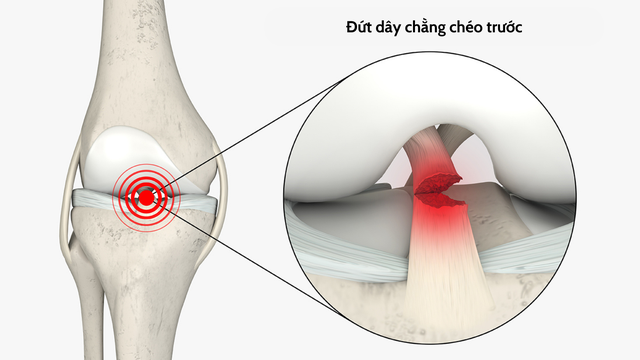 benh/dut-day-chang.html