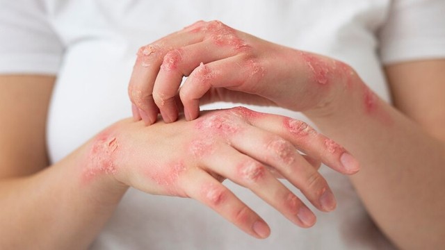 bai-viet/eczema-main-nguyen-nhan-trieu-chung-va-phuong-phap-dieu-tri.html