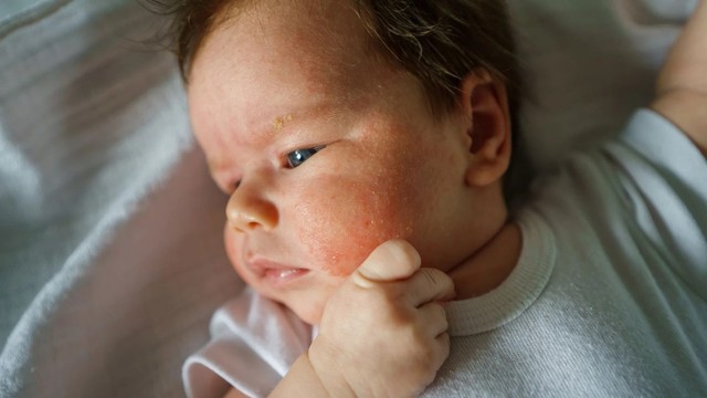 bai-viet/em-be-bi-noi-man-do-tren-mat-nguyen-nhan-va-cach-xu-tri.html