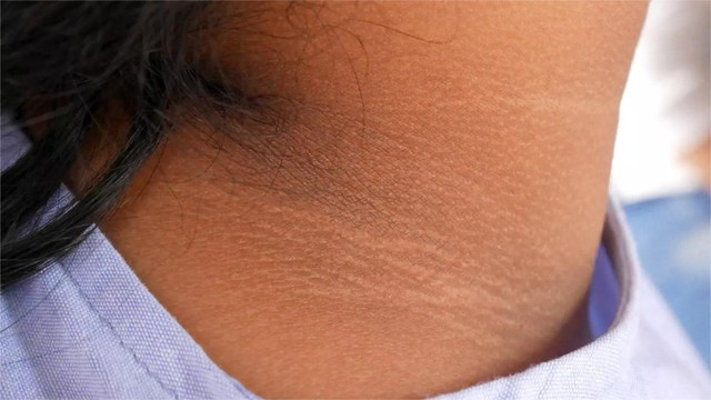 benh/gai-den-521.html