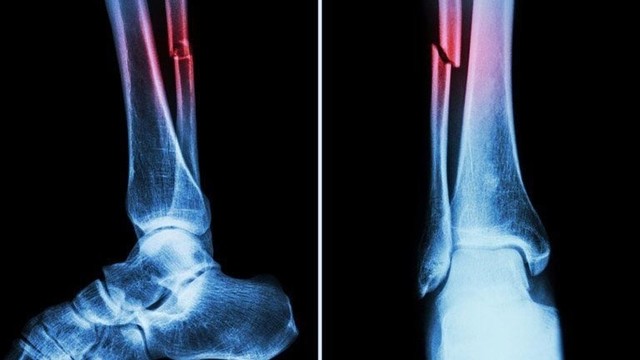 bai-viet/gay-1-3-duoi-xuong-mac-co-nguy-hiem-khong.html