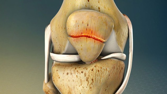 bai-viet/gay-xuong-banh-che-co-nguy-hiem-khong-va-cach-khac-phuc.html