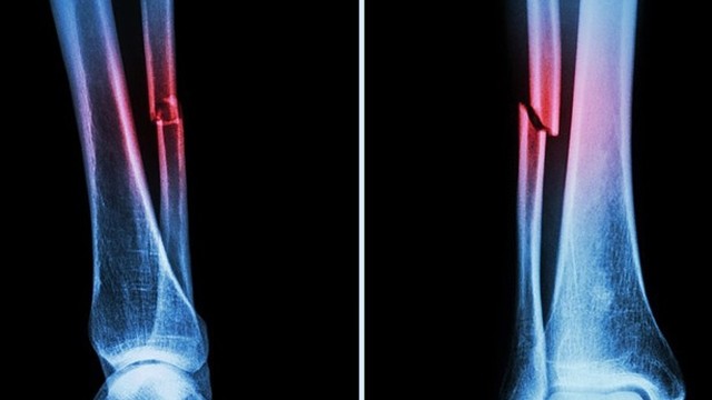 bai-viet/gay-xuong-mac-bao-lau-thi-lanh-ban-da-biet-chua.html