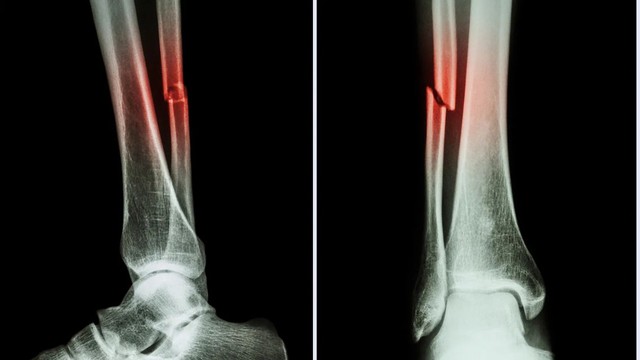 bai-viet/gay-xuong-mac-co-da-bong-duoc-khong-loi-khuyen-tu-chuyen-gia.html