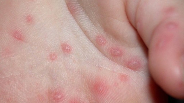 bai-viet/ghe-nuoc-o-tre-la-gi-co-de-lai-bien-chung-khong.html