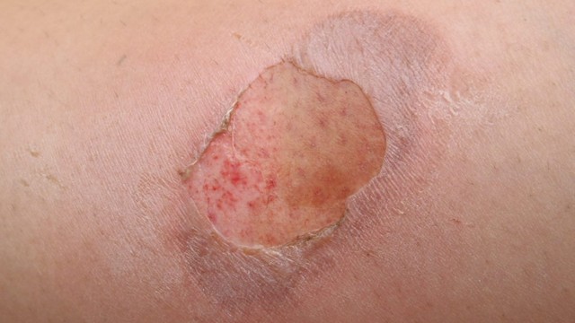 bai-viet/ghep-da-la-gi-nhung-dieu-ban-can-biet-ve-phuong-phap-nay.html